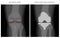 Meniscus _Arthritic knee and Total knee replacement