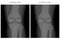 Meniscus _Normal knee and arthritic knee