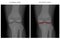 Meniscus _Normal knee and arthritic knee 2
