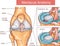 Meniscus tear and surgery