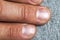 Mens fingers and nails in bad condition close up