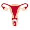 Menstrual cup in use, female period hygiene product in uterus. Vector illustration isolated on white.