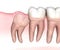 Mesial impaction of Wisdom tooth. Medically accurate tooth 3D illustration