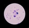 Mesothelial malignant cells with multiple nuclei