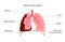 Mesothelioma cancer disease