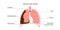 Mesothelioma cancer disease