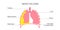 Mesothelioma cancer disease