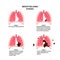 Mesothelioma cancer stages