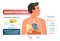 Mesothelioma vector illustration. Labeled lung cancer educational scheme.