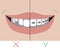 A metal braces and crooked teeth with a smile as a treatment concept in a dental or orthodontic clinic, a vector stock