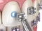 Metal braces installation process. Medically accurate dental 3D illustration