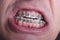 Metal orthodontic braces on crooked ugly teeth close-up. Ugly smile. Dental concept, medicinal alignment of teeth, brackets