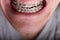 Metal orthodontic braces on crooked ugly teeth close-up. Ugly smile. Dental concept, medicinal alignment of teeth, brackets