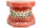 Metal wired dental braces