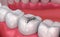 Metall dental fillings, Medically accurate
