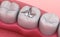 Metall dental fillings, Medically accurate