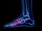 The metatarsal bone