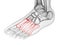 The metatarsal bone