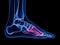 the metatarsal bone