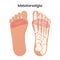 Metatarsalgia Pain in the Ball of the Foot medical educational vector illustration graphic