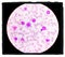 Microscopic examination of blasts or leukemia cells in blood smear of human.