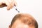 Middle-aged man concerned by hair loss Baldness alopecia close up white background