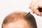 Middle-aged man concerned by hair loss Baldness alopecia close up white background
