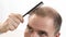 Middle-aged man concerned by hair loss Baldness alopecia close up white background