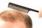 Middle-aged man concerned by hair loss Baldness alopecia close up white background