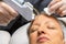 Middle aged woman having mesotherapy micro needling therapy on forehead