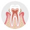 Middle stage Periodontal disease - Tooth cross section