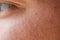 Milia Milium - pimples around eye on skin. Eyes of young man with small papillomas on eyelids or growths on skin