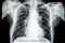 miliary pulmonary tuberculosis