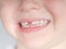Missing front tooth
