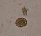Mixed Ascaris lumbricoides and Trichulis trichiura egg in stool examination
