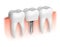 Model of teeth and dental implant