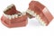 Model of Teeth with Lingual Braces