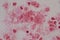 Moderate gram  nagative bacilli with white blood cells