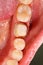 Molar Prepared For Dental Crown