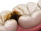 Molar teeth damaged by caries. Medically accurate tooth 3D illustration