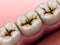 Molar teeth damaged by caries. Medically accurate tooth 3D illustration