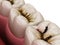 Molar teeth damaged by caries. Medically accurate tooth 3D illustration