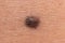 Mole birthmark nevus macro photo on human skin. Close up.