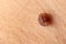 Mole birthmark nevus macro photo on human skin. Close up.