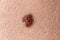 Mole birthmark nevus macro photo on human skin. Close up