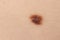 Mole birthmark nevus macro photo on human skin. Close up.