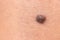 Mole birthmark nevus macro photo on human skin. Close up.