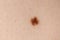 Mole birthmark nevus macro photo on human skin. Close up.