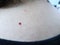 Mole birthmark on young woman skin