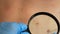 Mole dermoscopy, preventive of melanoma. Dermatologist examining patient's birthmark with magnifying glass in clinic